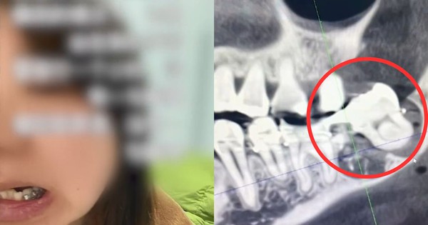 Đi nhổ răng khôn bị bác sĩ nhổ nhầm răng thật, người phụ nữ có lựa chọn tiêu cực avatar1742442052706 1742442052998675379271jpg