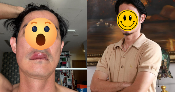 Sao nam Vbiz phát hoảng vì mặt biến dạng, sưng phồng bất thường avatar1743399040257 1743399050491231932068png