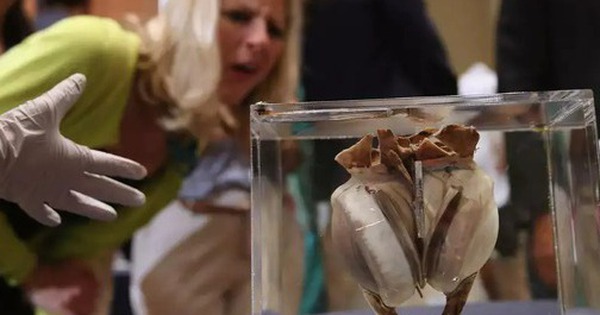 Ngày định mệnh của y học hiện đại: Ca cấy ghép tim nhân tạo đầu tiên trên thế giới và hành trình vượt qua giới hạn sự sống avatar1743828399547 1743828399839801808792 0 47 315 551 crop 17438284166442060234954jpg