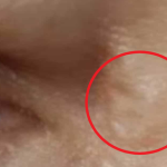 Khối u nhỏ xuất hiện gần mắt, 1 thời gian sau người phụ nữ tá hỏa thấy 1 sinh vật lạ sống trên mặt mình avatar1743840219696 17438402203431898452701png