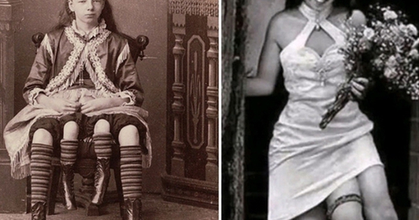 Cô gái có 4 chân, sở hữu cơ thể đặc biệt: 2 "vùng kín", 2 xương chậu, sống cuộc đời trọn vẹn avatar1744441438742 1744441439177207677522 0 36 315 540 crop 17444414630341328453431jpg