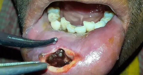 Mexico: Cảnh báo sự xuất hiện của bệnh giòi 'ăn thịt' người avatar1745064345217 1745064345455625228834jpg