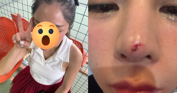 Thêm sao nữ Vbiz gặp tai nạn trên sân pickleball, vết thương chảy máu giữa mặt avatar1745072644536 1745072645189598734970 0 0 578 1104 crop 1745072686911917483432png