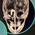 Say rượu ngã trên bàn ăn, người đàn ông bị thanh kim loại đâm xuyên não avatar1745209406844 1745209407205261058795 0 48 275 488 crop 1745209434378978030282jpeg