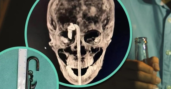 Say rượu ngã trên bàn ăn, người đàn ông bị thanh kim loại đâm xuyên não avatar1745209406844 1745209407205261058795 0 48 275 488 crop 1745209434378978030282jpeg