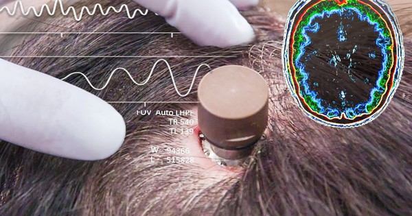 Người đàn ông bị liệt chỉnh sửa video, đăng YouTube 'chỉ bằng suy nghĩ': Ca cấy chip não Neuralink thứ ba gây chấn động avatar1746457207868 1746457208177293884936 0 128 720 1280 crop 1746457240096320237955jpg