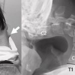 Nam game thủ "vẹo cổ" do chơi game, nhìn ảnh chụp phim mà... rợn người avatar1747643230494 17476432312291981493499jpg