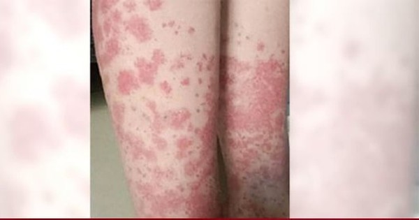 Nữ sinh trả giá đắt vì nhuộm tóc liên tục: Thận chảy máu, phải cạo đầu giữ mạng avatar1749949472331 17499494728021348532462 0 71 277 600 crop 17499494869161605442456jpg