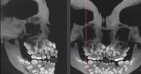 Bé gái 11 tuổi có tới 81 chiếc răng trong miệng, hình ảnh X-quang gây sốc avatar1752627252157 17526272525161195719549png