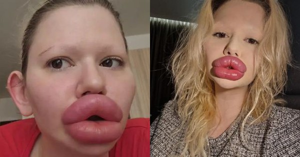 Lộ ảnh trước phẫu thuật gây sốc của “người phụ nữ có đôi môi lớn nhất thế giới”: Ai nấy đều sửng sốt avatar1753689934030 17536899344622082240971jpg