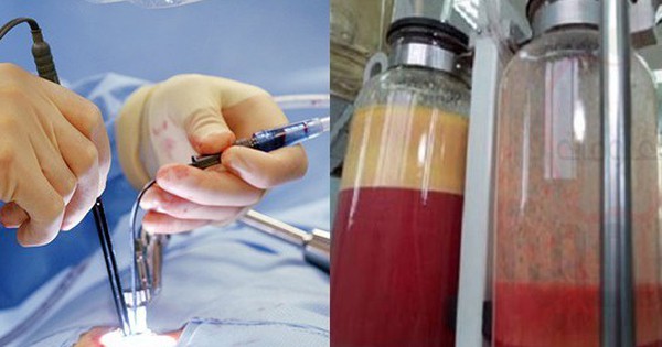 Bê bối của thị trường thẩm mỹ trị giá 22 tỉ USD: nạn nhân nức nở kể trải nghiệm HÚT MỠ đau đớn "như bị lột da sống" avatar1753694682418 1753694682694903477603 0 49 340 593 crop 17536946986471803754713jpg