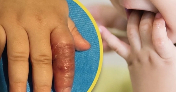 Mẹ dùng băng quấn để ngăn con mút tay, em bé suýt phải cắt cụt ngón avatar1753838405560 17538384060003782695 0 86 272 522 crop 17538384282241088969046jpeg