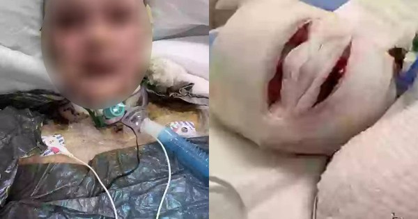 Cơn ác mộng của người mẹ sau sinh con thứ ba: Mất 90-95% da toàn cơ thể, chỉ còn 5% cơ hội sống chỉ vì một loại thuốc giảm đau quen thuộc avatar1754989246807 17549892471092058159499jpg