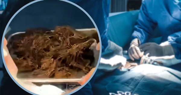 Cao 1m6 nhưng chỉ nặng 35kg, bé gái 15 tuổi nhập viện, bác sĩ bàng hoàng phát hiện thứ trong bụng bệnh nhi avatar1755514349434 17555143498282024030516png