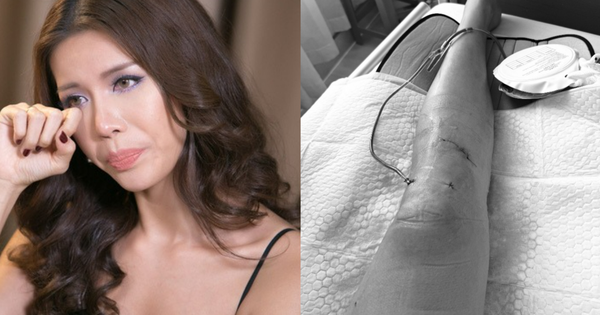 Siêu mẫu Minh Tú sốc vì bị đứt dây chằng chéo trước, rách sụn, dập xương avatar1756516097548 1756516098018925770956png