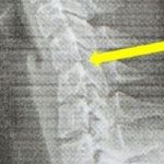 Cô gái 20 tuổi sở hữu cột sống cổ của người 60 vì nghiện chơi game avatar1757911897867 1757911898784728746104jpg