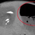 Bụng bé gái sưng to bất thường, bác sĩ phát hiện ra "bí mật" đáng sợ avatar1760248935361 17602489356861100168698jpg