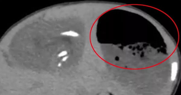 Bụng bé gái sưng to bất thường, bác sĩ phát hiện ra "bí mật" đáng sợ avatar1760248935361 17602489356861100168698jpg