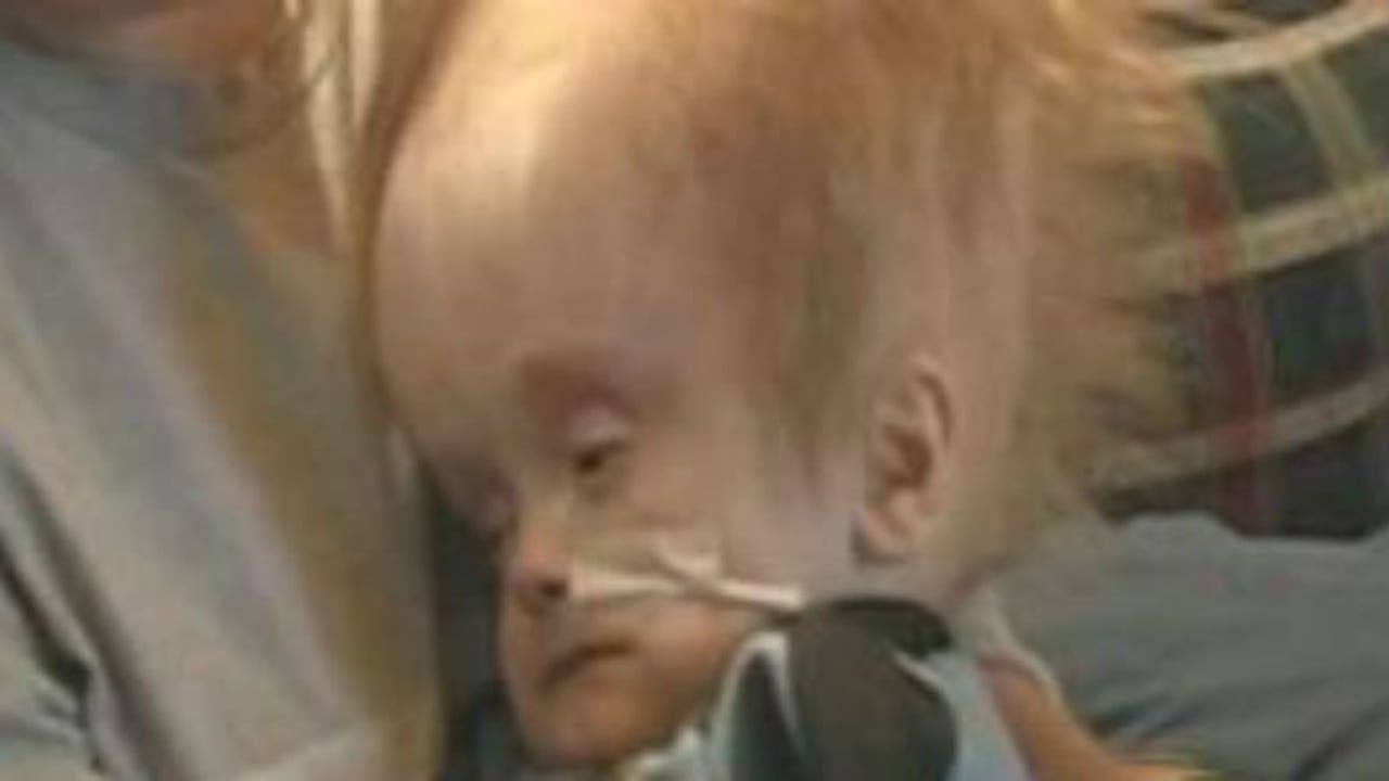 Cậu bé sinh ra không có não đã sống cuộc đời như thế nào?- Ảnh 2. Cậu bé sinh ra không có não đã sống cuộc đời như thế nào?- Ảnh 2.