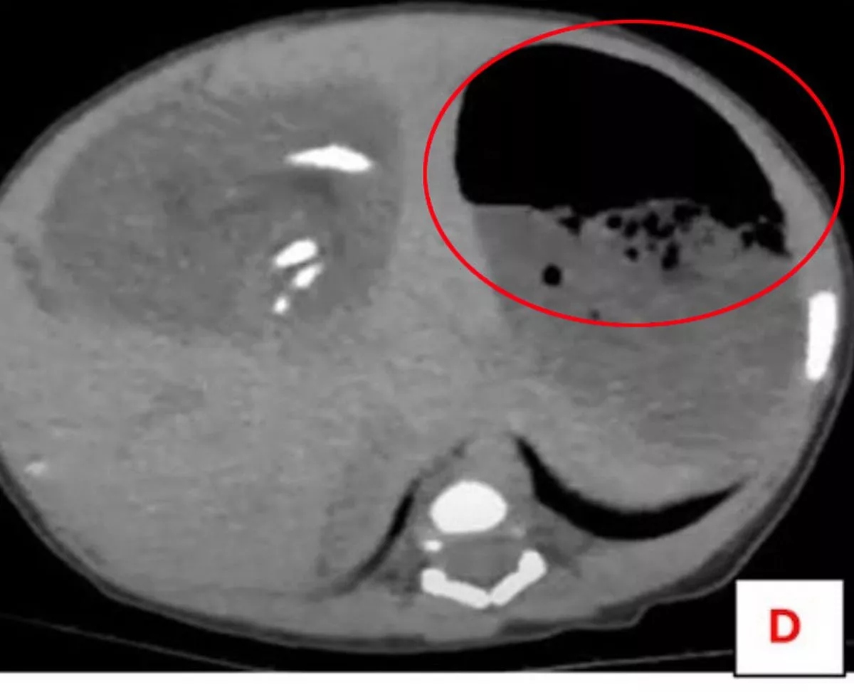 Bụng bé gái sưng to bất thường, bác sĩ phát hiện ra