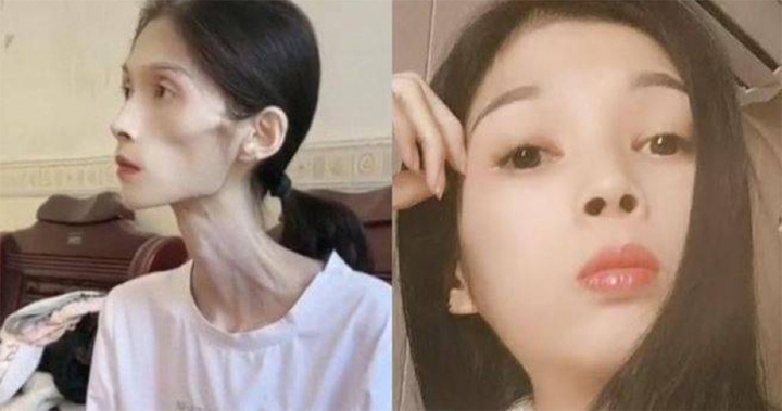 Số phận bi thảm của cô gái xinh đẹp biến thành 'bộ xương di động' 17kg- Ảnh 1. Số phận bi thảm của cô gái xinh đẹp biến thành 'bộ xương di động' 17kg- Ảnh 1.