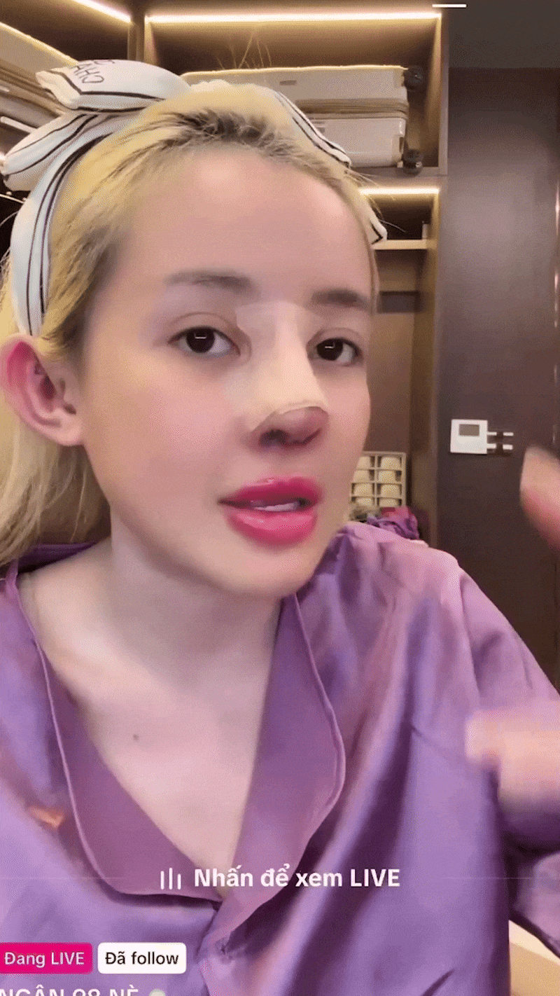 Ngân 98 sau khi tháo mũi vì nhiễm trùng: Bị lấy 2 khúc xương sườn, ngất xỉu vì quá đau- Ảnh 1. Ngân 98 sau khi tháo mũi vì nhiễm trùng: Bị lấy 2 khúc xương sườn, ngất xỉu vì quá đau- Ảnh 1.