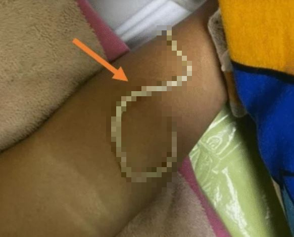 Bé trai 3 tuổi nôn ra giun, đến khi phẫu thuật bác sĩ càng bất ngờ- Ảnh 1.