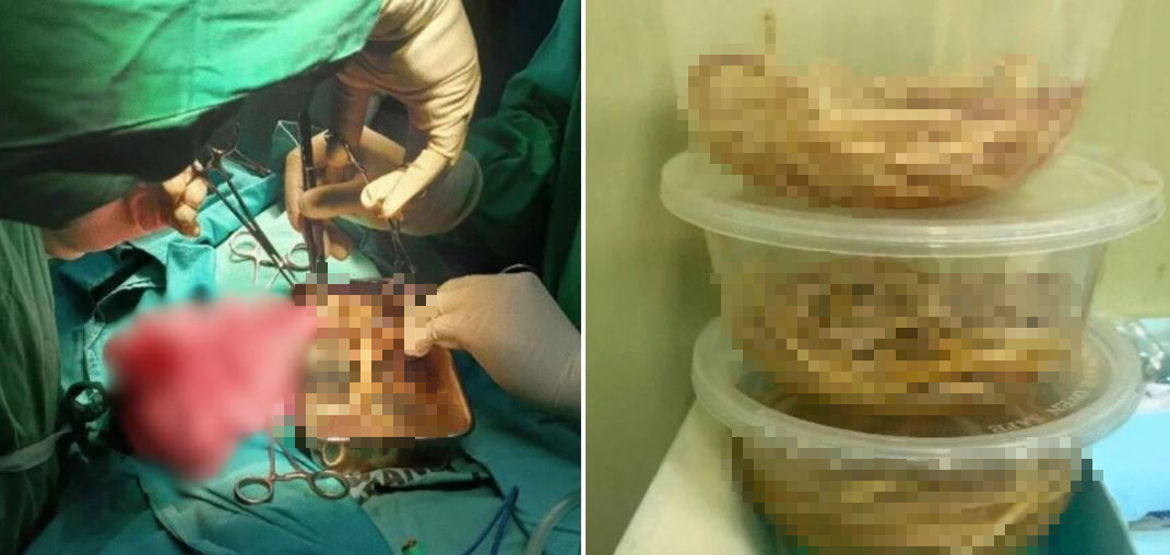 Bé trai 3 tuổi nôn ra giun, đến khi phẫu thuật bác sĩ càng bất ngờ- Ảnh 2.