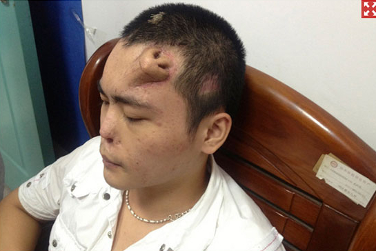 Không phải ảnh lỗi của AI, người đàn ông này đã thực sự mọc một chiếc mũi trên trán: Đó là