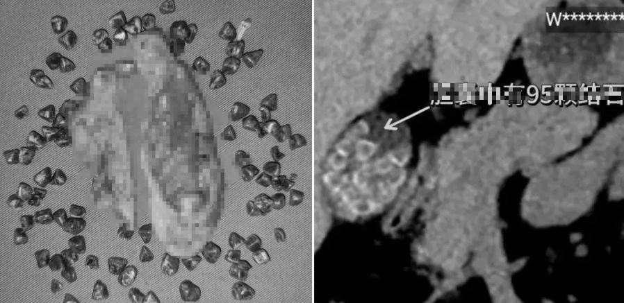 Hơn 10 năm bỏ bữa sáng và ăn vặt đêm khuya, đi khám người phụ nữ phát hiện