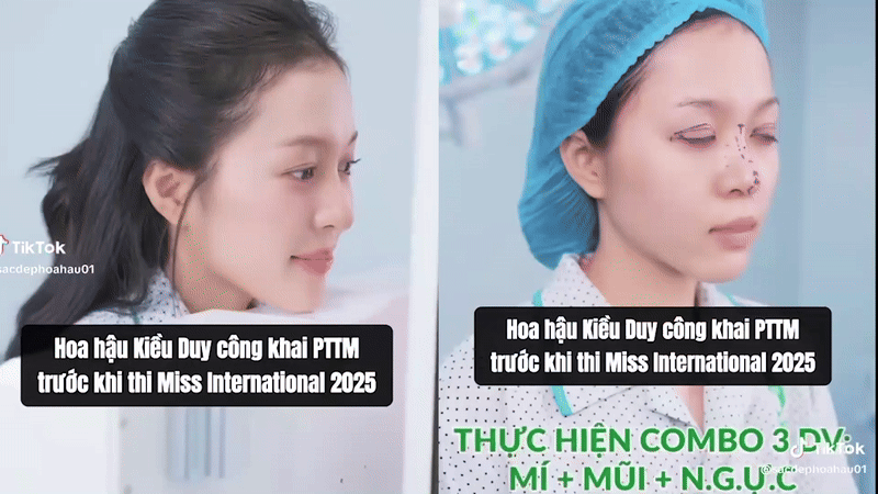 Thêm Hoa hậu 2k3 nhà Sen Vàng công khai “dao kéo” trước thềm thi Quốc tế- Ảnh 1. Thêm Hoa hậu 2k3 nhà Sen Vàng công khai “dao kéo” trước thềm thi Quốc tế- Ảnh 1.