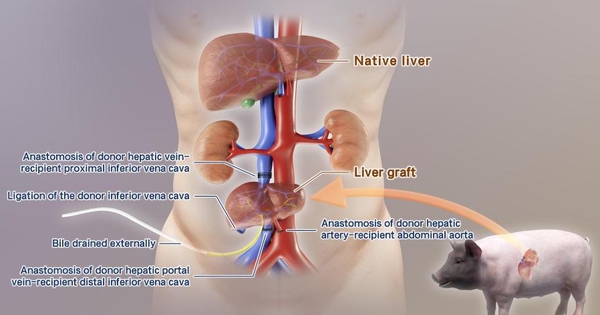 Trung Quốc cấy ghép thành công gan lợn chỉnh sửa gen vào cơ thể người gheptang 1743135618972 1743135619314274287050 0 30 561 928 crop 1743135642830254959318jpg