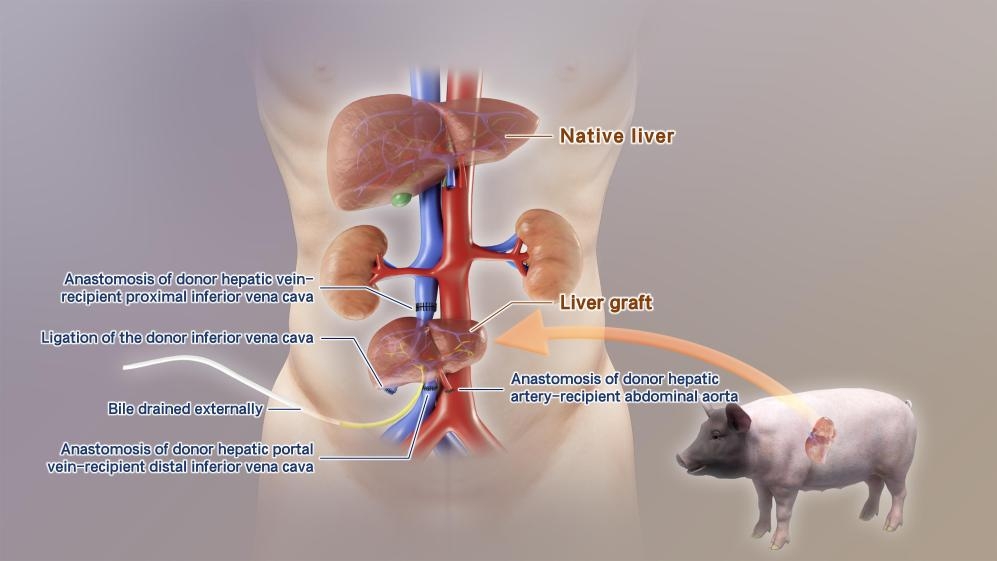 Trung Quốc cấy ghép thành công gan lợn chỉnh sửa gen vào cơ thể người- Ảnh 1.