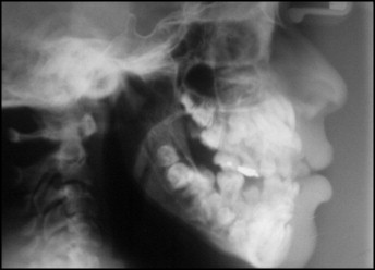 Bé gái 11 tuổi có tới 81 chiếc răng trong miệng, hình ảnh X-quang gây sốc- Ảnh 1.