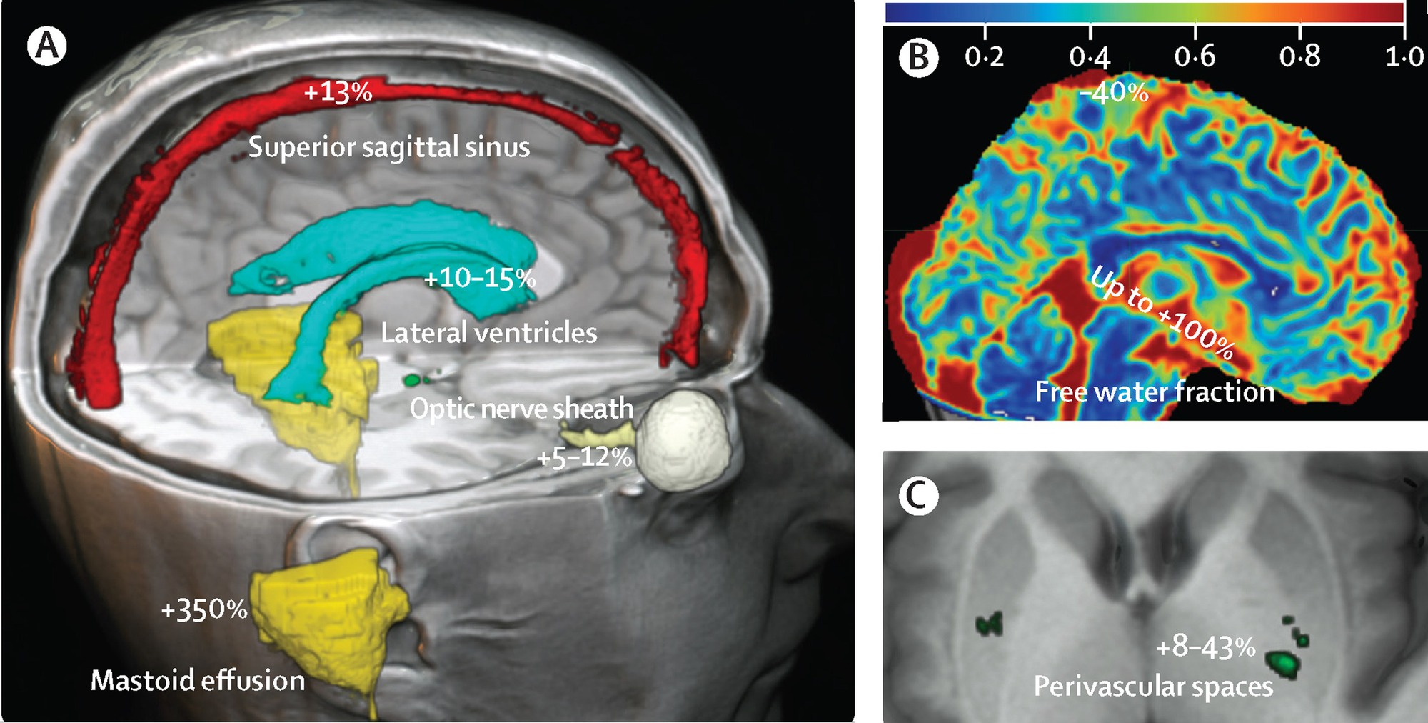 Quét não của 30 phi hành gia bằng MRI trước và sau khi bay vào vũ trụ, các chuyên gia có phát hiện sốc- Ảnh 2.