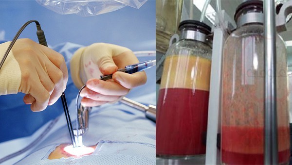 Bê bối của thị trường thẩm mỹ trị giá 22 tỉ USD: nạn nhân nức nở kể trải nghiệm HÚT MỠ đau đớn Bê bối của thị trường thẩm mỹ trị giá 22 tỉ USD: nạn nhân nức nở kể trải nghiệm HÚT MỠ đau đớn