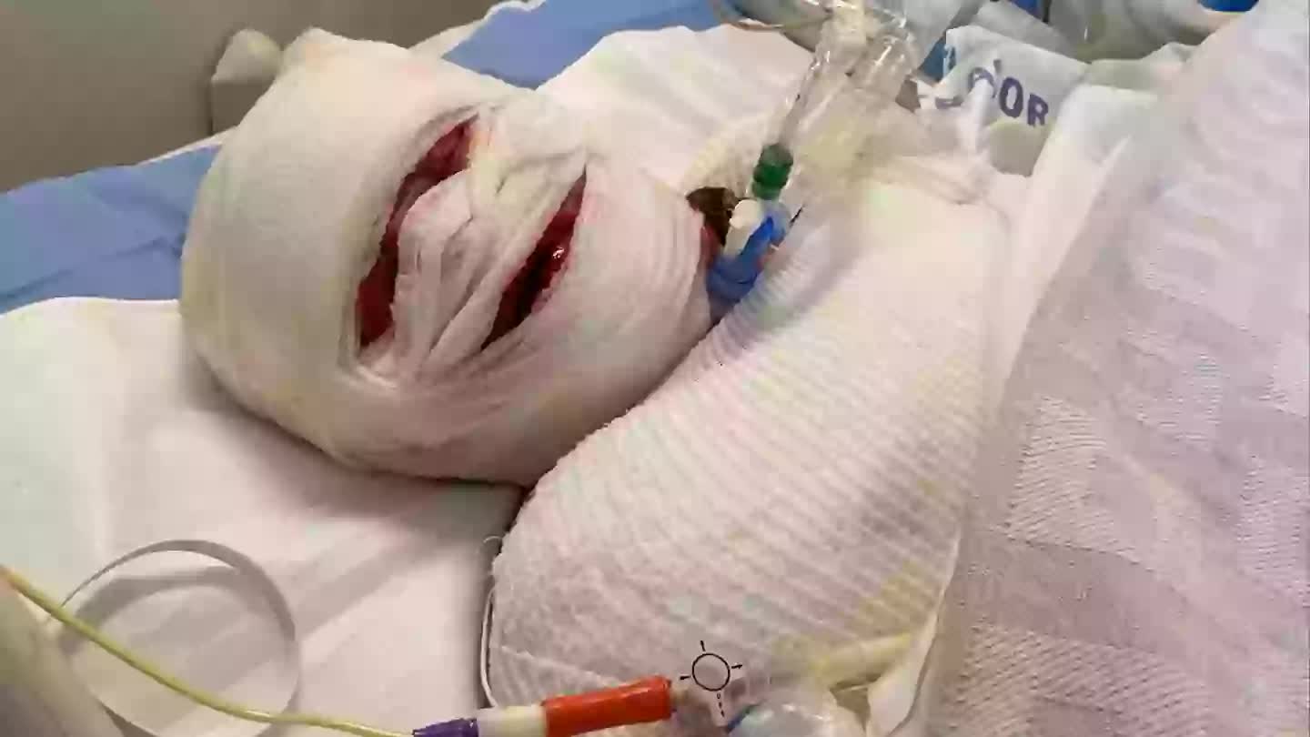 Cơn ác mộng của người mẹ sau sinh con thứ ba: Mất 90-95% da toàn cơ thể, chỉ còn 5% cơ hội sống chỉ vì một loại thuốc giảm đau quen thuộc- Ảnh 1.