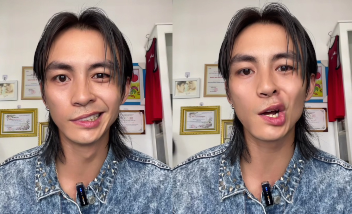 Nam thần Vbiz tiết lộ bị liệt dây thần kinh số 7: Mặt biến dạng, mất luôn giọng nói- Ảnh 6. Nam thần Vbiz tiết lộ bị liệt dây thần kinh số 7: Mặt biến dạng, mất luôn giọng nói- Ảnh 6.