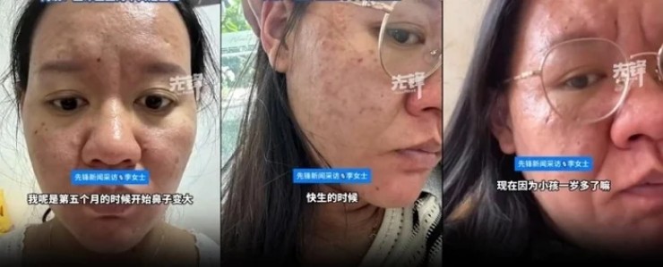 me-bim-gay-bao-mang-vi-mat-mui-bien-dang-khi-mang-thai-1-1748997640-982-width740height299 Ngoại hình của cô thay đổi đáng kể từ tháng thứ 5.