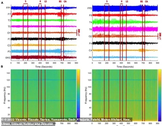 Khoa học lần đầu ghi lại được sóng não của người cận tử, liệu thực sự có trải nghiệm