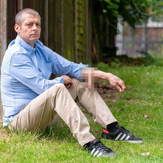 Không phải ảnh lỗi của AI, người đàn ông này đã thực sự mọc một chiếc mũi trên trán: Đó là