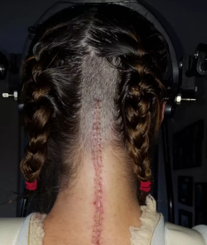 Bị 'rụng đầu khỏi cổ', người phụ nữ trải qua 37 ca phẫu thuật để giữ tính mạng- Ảnh 2. Bị 'rụng đầu khỏi cổ', người phụ nữ trải qua 37 ca phẫu thuật để giữ tính mạng- Ảnh 2.