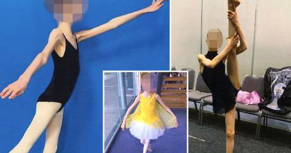 Cha mẹ ép con giảm cân chỉ còn 27kg, cô gái 20 tuổi vẫn cầu xin một điều khiến ai cũng nghẹn ngào ncer weighed 60 98662757 17397846259391729042789 13 0 299 457 crop 173978463195264562384 1739795497405 1739795497619900975015 0 0 477 764 crop 17397955435761079402649jpg