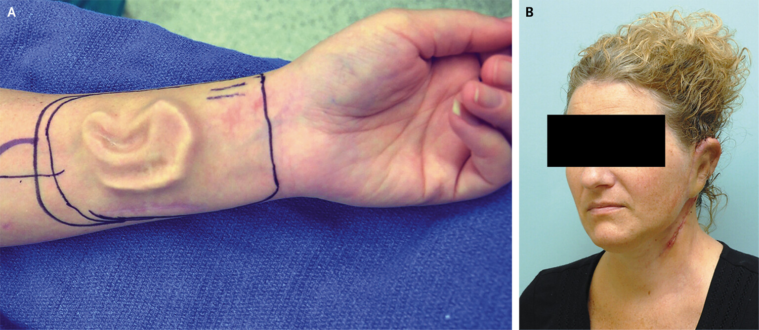 Không phải ảnh lỗi của AI, người đàn ông này đã thực sự mọc một chiếc mũi trên trán: Đó là