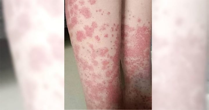 Nữ sinh trả giá đắt vì nhuộm tóc liên tục: Thận chảy máu, phải cạo đầu giữ mạng- Ảnh 1.