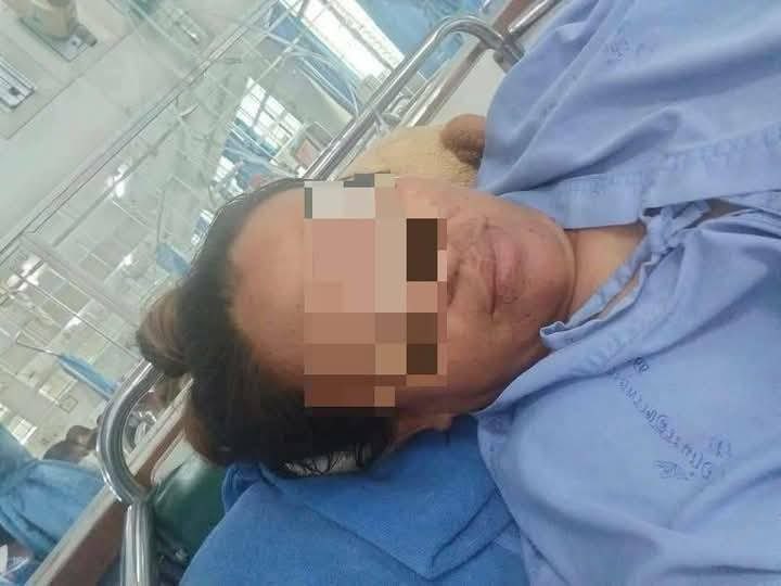 Bị rắn hổ mang chúa cắn khi hái nấm, người phụ nữ dùng tay không đánh chết rồi xách đến bệnh viện, bác sĩ choáng váng- Ảnh 1.