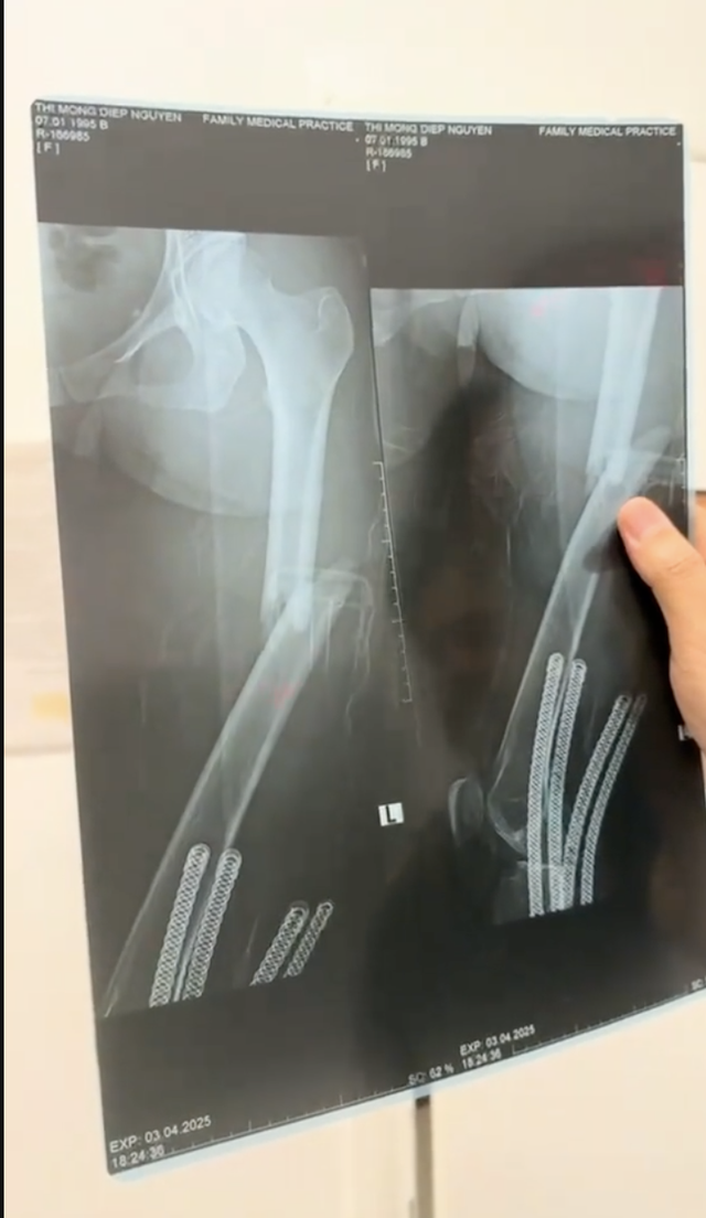 Thêm sao nữ Vbiz gặp tai nạn trên sân pickleball, vết thương chảy máu giữa mặt- Ảnh 6.