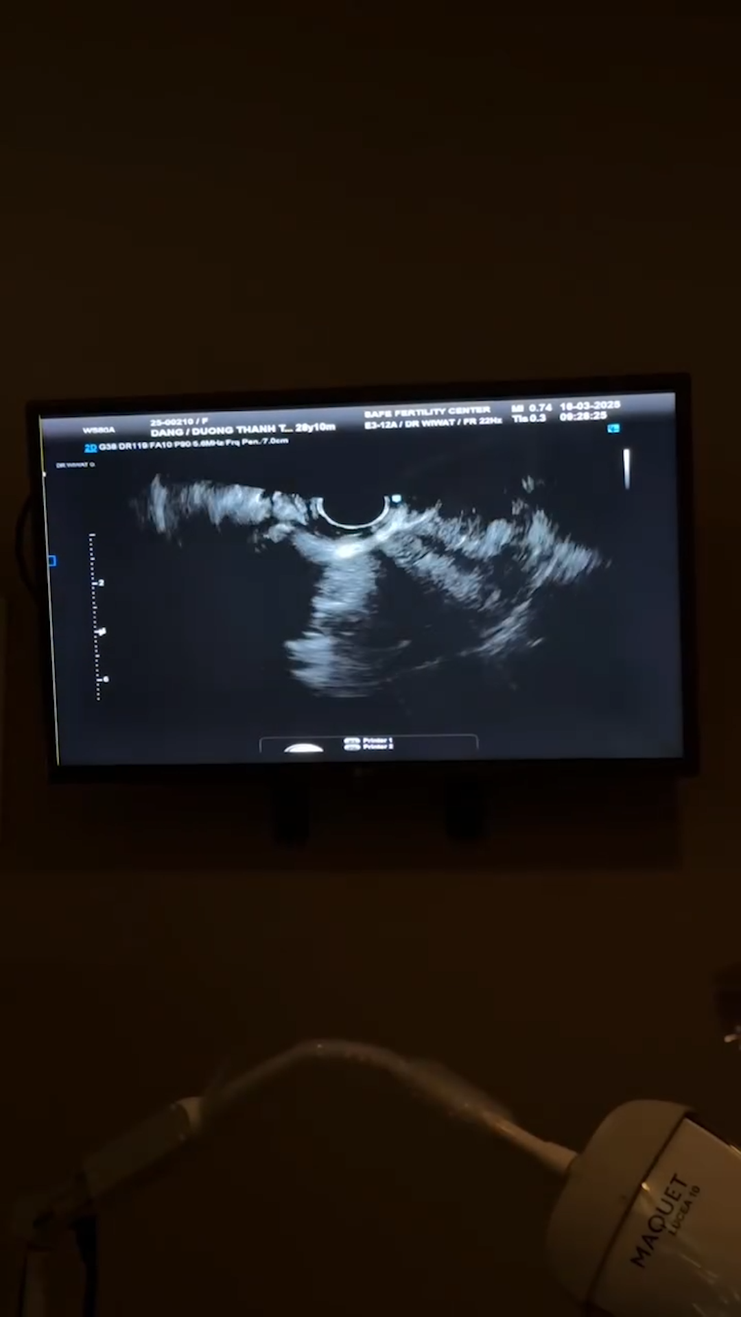 Sao nữ Vbiz đi trữ trứng lần 2: Đau đớn vì tiêm liên tục 10 ngày, kết quả khiến bác sĩ bất ngờ- Ảnh 6.