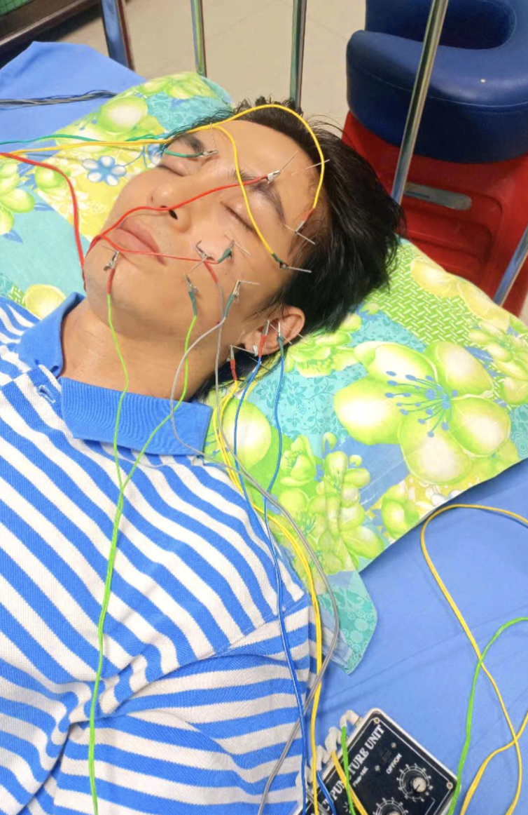 Nam thần Vbiz tiết lộ bị liệt dây thần kinh số 7: Mặt biến dạng, mất luôn giọng nói- Ảnh 7. Nam thần Vbiz tiết lộ bị liệt dây thần kinh số 7: Mặt biến dạng, mất luôn giọng nói- Ảnh 7.