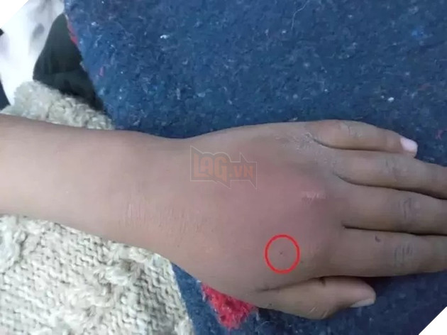 Để cho nhện cắn vào tay với mong muốn làm Spider-Man, cậu bé nhập viện trong nguy kịch